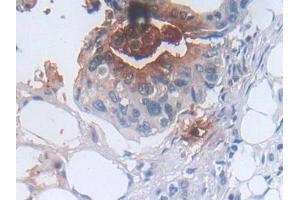 Detection of DEFa3 in Human Colorectal cancer Tissue using Polyclonal Antibody to Defensin Alpha 3, Neutrophil Specific (DEFa3) (DEFa3 抗体  (AA 21-94))