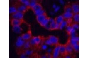 Immunofluorescence analysis of Human liver cancer tissue using CK-16 Monoclonal Antibody at dilution of 1:200. (KRT16 抗体)