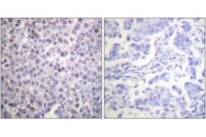 Immunohistochemistry analysis of paraffin-embedded human breast carcinoma tissue, using Histone H4 (Ab-12) Antibody. (Histone H4 抗体  (AA 10-59))