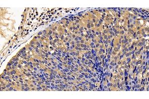 Detection of BLK in Human Breast cancer Tissue using Polyclonal Antibody to B-Lymphoid Tyrosine Kinase (BLK) (BLK 抗体  (AA 241-494))