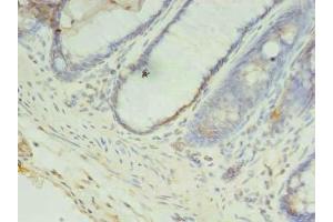 Immunohistochemistry of paraffin-embedded human colon cancer using ABIN7148128 at dilution of 1:100 (CCDC57 抗体  (AA 1-300))