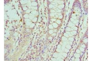 Immunohistochemistry of paraffin-embedded human colon cancer using ABIN7170857 at dilution of 1:100 (SMC1A 抗体  (AA 1-130))