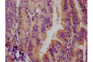 IHC image of ABIN7127694 diluted at 1:100 and staining in paraffin-embedded human endometrial cancer performed on a Leica BondTM system. (Recombinant FOXO3 抗体  (pSer253))