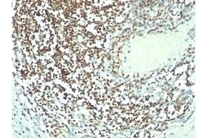 Formalin-fixed, paraffin-embedded human bladder carcinoma stained with Nucleolin antibody (364-5 + NCL/902). (Nucleolin 抗体)