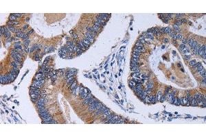 Immunohistochemistry of paraffin-embedded Human colon cancer using CA4 Polyclonal Antibody at dilution of 1:30 (CA4 抗体)