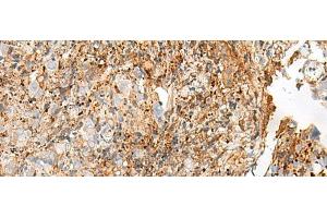 Immunohistochemistry of paraffin-embedded Human cervical cancer tissue using GPR27 Polyclonal Antibody at dilution of 1:25(x200) (GPR27 抗体)