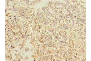 Immunohistochemistry of paraffin-embedded human pancreatic cancer using ABIN7172196 at dilution of 1:100 (TIGD7 抗体  (AA 1-300))