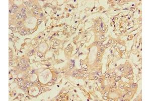 Immunohistochemistry of paraffin-embedded human pancreatic cancer using ABIN7158780 at dilution of 1:100 (CTSA 抗体  (AA 30-327))