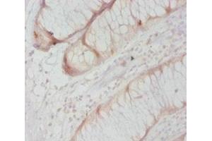 Immunohistochemistry of paraffin-embedded human colon cancer using ABIN7146964 at dilution of 1:20 (Caspase 8 抗体  (AA 217-374))