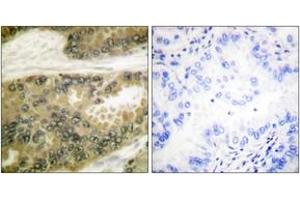 Immunohistochemistry analysis of paraffin-embedded human lung carcinoma tissue, using Cyclin D3 (Ab-283) Antibody. (Cyclin D3 抗体  (AA 243-292))