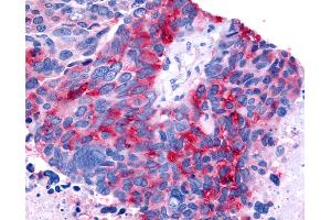 Anti-RORB / ROR Beta antibody IHC of human Lung, Small Cell Carcinoma. (RORB 抗体  (Ligand Binding Domain))