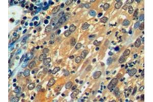 DAB staining on IHC-P; Samples: Human Endometrial cancer Tissue (HSPA1L 抗体  (AA 1-641))