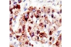 IHC analysis of FFPE human hepatocarcinoma stained with the Ubiquitin antibody (Ubiquitin 抗体  (AA 36-66))