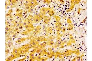 IHC image of ABIN7173899 diluted at 1:500 and staining in paraffin-embedded human liver cancer performed on a Leica BondTM system. (EDAR 抗体  (AA 27-170))