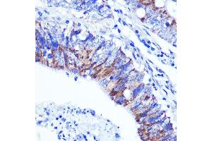 Immunohistochemistry of paraffin-embedded human colon carcinoma using PALLD Rabbit pAb  at dilution of 1:100 (40x lens). (PALLD 抗体  (AA 383-672))