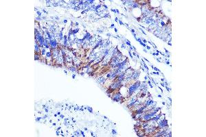 Immunohistochemistry of paraffin-embedded human colon carcinoma using PALLD Rabbit pAb  at dilution of 1:100 (40x lens). (PALLD 抗体  (AA 383-672))