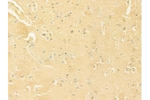 ABIN6263643 and ABIN6277805 at 1/100 staining human glioblastoma by IHC-P. (NCR1 抗体  (Internal Region))