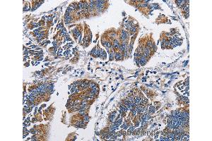 Immunohistochemistry of Human colon cancer using NPPA Polyclonal Antibody at dilution of 1:60 (NPPA 抗体)