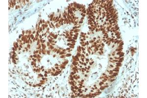Formalin-fixed, paraffin-embedded human Colon Carcinoma stained with MSH6 Mouse Monoclonal Antibody (MSH6/3091). (MSH6 抗体  (AA 374-540))