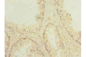 Immunohistochemistry of paraffin-embedded human prostate cancer using ABIN7166868 at dilution of 1:100 (PLPBP 抗体  (AA 1-275))