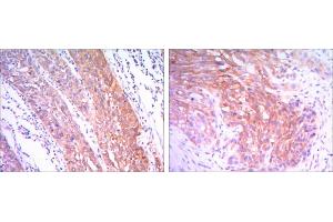Immunohistochemical analysis of paraffin-embedded esophagus cancer tissues (left) and human lung cancer (right) using HK2 antibody with DAB staining. (Hexokinase 2 抗体)
