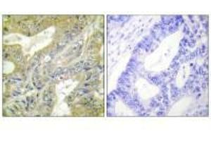 Immunohistochemistry analysis of paraffin-embedded human colon carcinoma tissue using HEXB antibody. (HEXB 抗体  (C-Term))