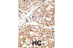 Formalin-fixed and paraffin-embedded human cancer tissue reacted with the primary antibody, which was peroxidase-conjugated to the secondary antibody, followed by DAB staining. (BOK 抗体  (AA 60-90))