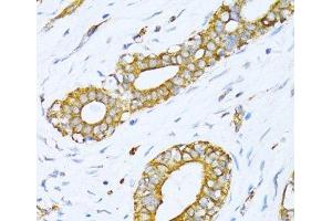 Immunohistochemistry of paraffin-embedded Human breast cancer using VARS Polyclonal Antibody at dilution of 1:100 (40x lens). (VARS 抗体)