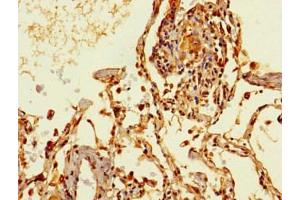 Immunohistochemistry of paraffin-embedded human lung cancer using ABIN7172158 at dilution of 1:100 (THRSP 抗体  (AA 41-144))