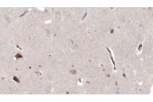 ABIN6272964 at 1/100 staining Human brain cancer tissue by IHC-P. (MPV17 抗体  (Internal Region))