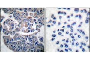 Immunohistochemistry analysis of paraffin-embedded human breast carcinoma, using eEF2K (Phospho-Ser366) Antibody. (EEF2K 抗体  (pSer366))