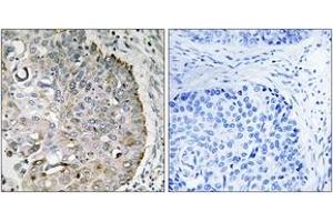 Immunohistochemistry analysis of paraffin-embedded human lung carcinoma tissue, using MRRF Antibody. (MRRF 抗体  (AA 181-230))