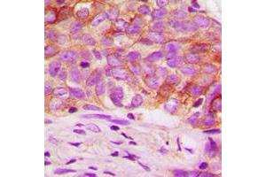 Immunohistochemical analysis of Ezrin (pT567) staining in human breast cancer formalin fixed paraffin embedded tissue section.