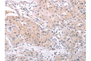 The image on the left is immunohistochemistry of paraffin-embedded Human lung cancer tissue using ABIN7131156(SPATA16 Antibody) at dilution 1/25, on the right is treated with fusion protein. (SPATA16 抗体)