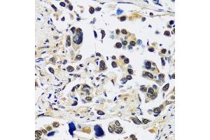 Immunohistochemistry of paraffin-embedded human lung cancer using CCDC59 antibody (ABIN7266440) at dilution of 1:100 (40x lens). (CCDC59 抗体  (AA 1-241))