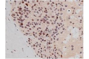 ABIN6267361 at 1/200 staining Human liver cancer tissue sections by IHC-P. (MAPT 抗体  (pThr181))