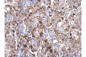 IHC-P Image MAF1 antibody detects MAF1 protein at nucleus on human endometrial carcinoma by immunohistochemical analysis. (MAF1 抗体  (Center))