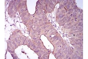 Immunohistochemical analysis of paraffin-embedded rectum cancer tissues using EGFR mutant mouse mAb with DAB staining. (EGFR Mutant (AA 693-893) 抗体)