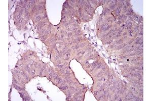 Immunohistochemical analysis of paraffin-embedded rectum cancer tissues using EGFR mutant mouse mAb with DAB staining. (EGFR 抗体  (Mutant))
