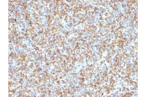 Formalin-fixed, paraffin-embedded human Ewing's sarcoma stained with anti-Vimentin antibody (VM1170). (Vimentin 抗体)