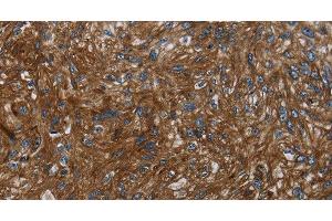 Immunohistochemistry of paraffin-embedded Human esophagus cancer tissue using KISS1R Polyclonal Antibody at dilution 1:30 (KISS1R 抗体)