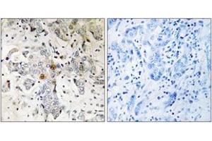 Immunohistochemistry analysis of paraffin-embedded human breast carcinoma tissue, using ZCCHC17 Antibody. (ZCCHC17 抗体  (AA 51-100))