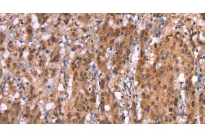 Immunohistochemistry of paraffin-embedded Human gasrtic cancer tissue using AMER1 Polyclonal Antibody at dilution 1:40 (WTX 抗体)