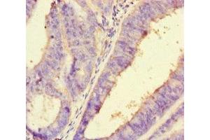 Immunohistochemistry of paraffin-embedded human endometrial cancer using ABIN7162730 at dilution of 1:100 (PDLIM5 抗体  (AA 268-404))