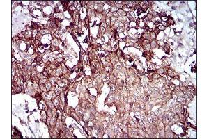 Immunohistochemical analysis of paraffin-embedded esophageal cancer tissues using DSG3 mouse mAb with DAB staining. (Desmoglein 3 抗体  (AA 55-159))
