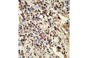Formalin-fixed and paraffin-embedded human lung carcinoma reacted with PS Antibody (Center), which was peroxidase-conjugated to the secondary antibody, followed by DAB staining. (PSMA7 抗体  (AA 100-126))
