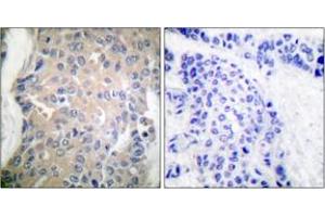 Immunohistochemistry analysis of paraffin-embedded human breast carcinoma tissue, using CPI17 alpha (Ab-38) Antibody. (CPI-17 抗体  (AA 5-54))