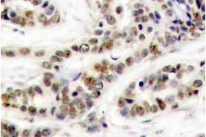 Immunohistochemistry (IHC) analyzes of p-CREB-1 antibody in paraffin-embedded human breast carcinoma tissue. (CREB1 抗体  (pSer129))