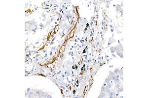 Immunohistochemistry of paraffin-embedded human lung cancer using CD146/MCAM Rabbit pAb (ABIN6127568, ABIN6143621, ABIN6143622 and ABIN6218100) at dilution of 1:25 (40x lens). (MCAM 抗体  (AA 447-646))