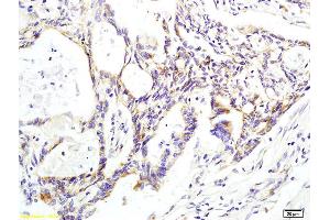 Formalin-fixed and paraffin embedded human colon carcinoma labeled with Anti phospho-CK II beta (Ser209) Polyclonal Antibody, Unconjugated (ABIN872284) at 1:200 followed by conjugation to the secondary antibody and DAB staining. (CSNK2B 抗体  (pSer209))